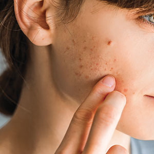 L'acné : mieux la comprendre pour mieux la traiter