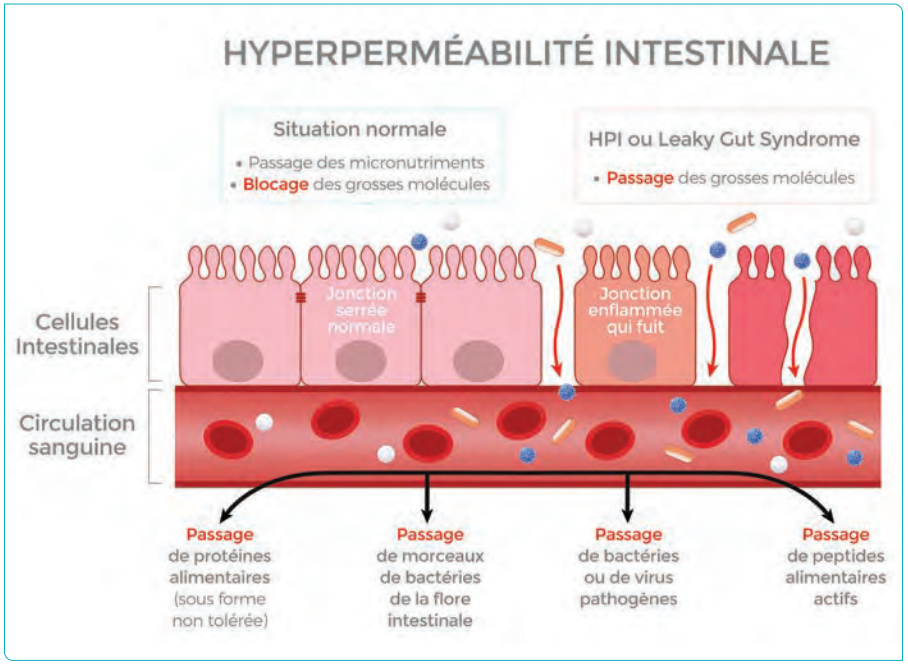 Hypermeabilité intestinale schema