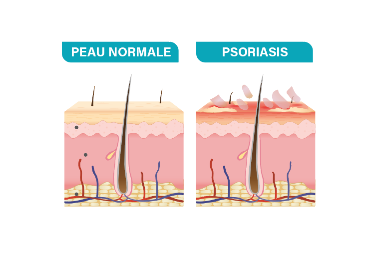 psoriasis