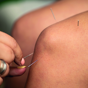 acupuncture