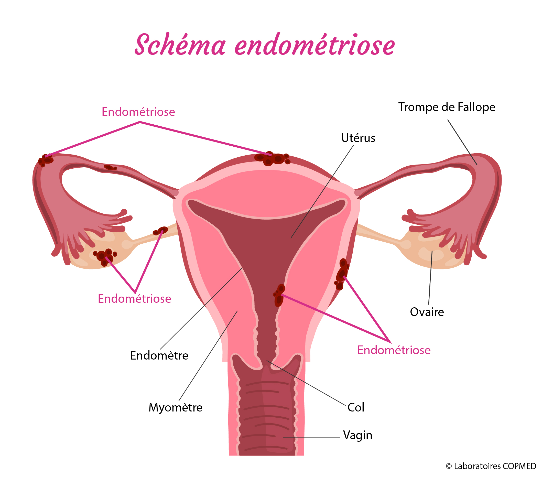 Schema endometriose