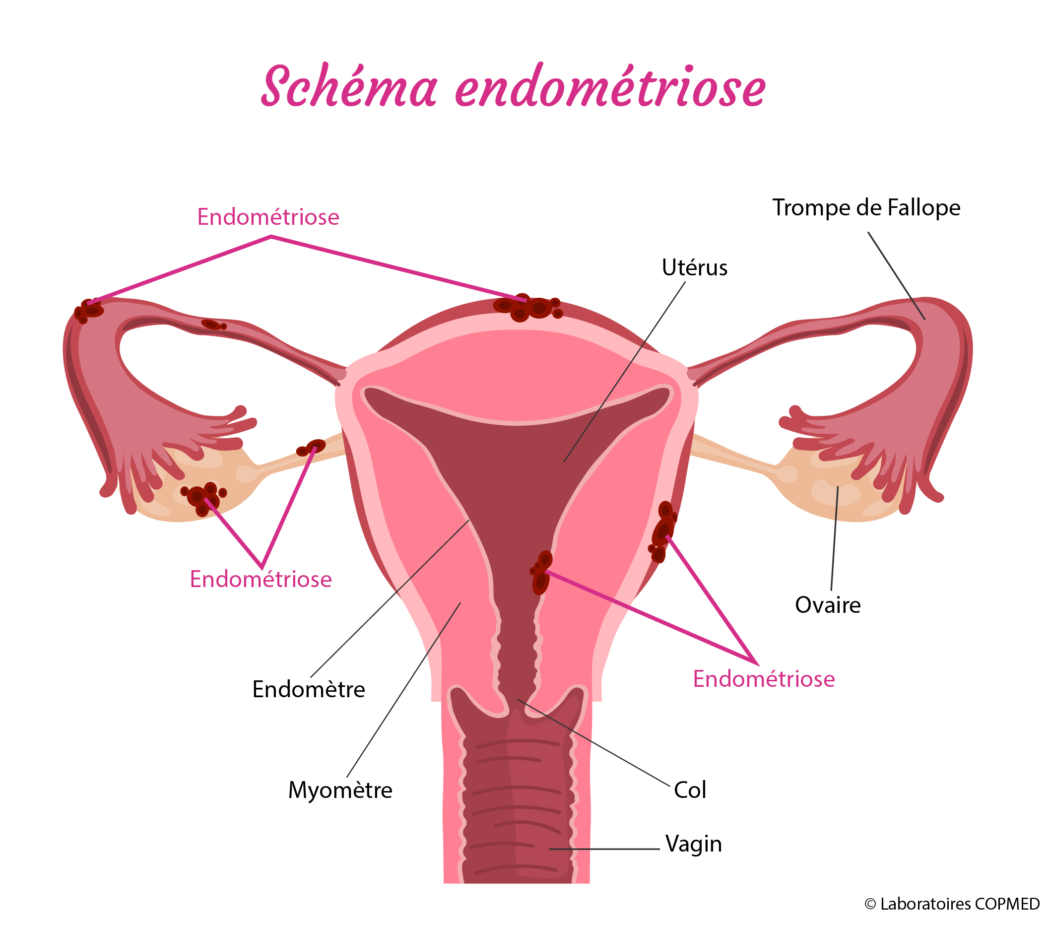 diagram endometriose