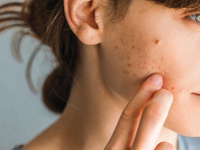 L'acné : mieux la comprendre pour mieux la traiter