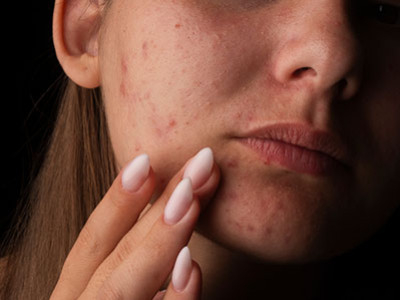 Qu'est-ce qu'une peau acnéique ?